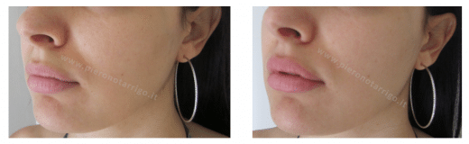 Ingrandimento labbra con acido ialuronico - Dott. Notarrigo - Medicina Estetica Bologna