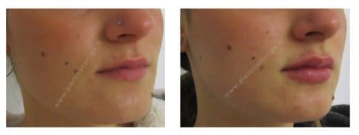 Ingrandimento labbra con acido ialuronico - Dott. Notarrigo - Medicina Estetica San Lazzaro