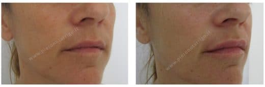 Ringiovanimento delle labbra - Dott. Notarrigo Medicina Estetica San Lazzaro di Savena
