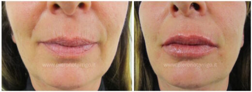 Ringiovanimento labbra – Medicina Estetica San Lazzaro di Savena